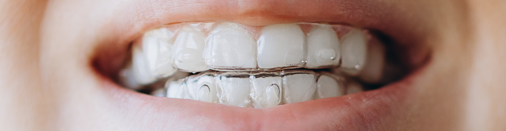 Close up of smile wearing clear retainers.